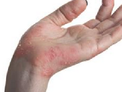 湿疹每年反复发作很痛苦，该如何解决？